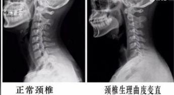 颈椎曲度变直锻炼视频,跟随视频轻松恢复健康曲线